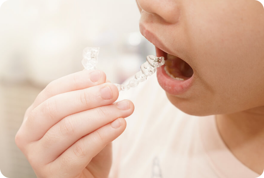 Why Invisalign First?