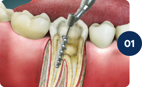 The tooth becomes weaker after RCT