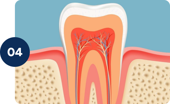 Seals the tooth from reinfection
