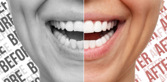 Why Porcelain Veneers? Why Porcelain Veneers?