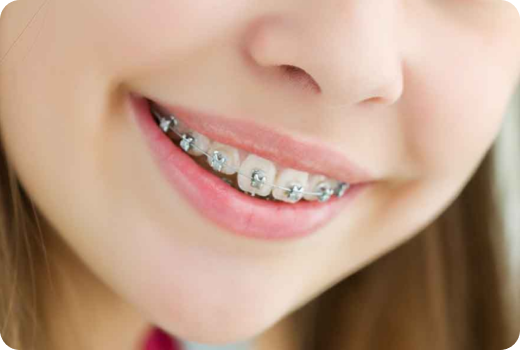 Why Self-ligating braces? Why Self-ligating braces?