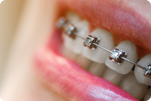 Why Self-ligating braces? Why Self-ligating braces?