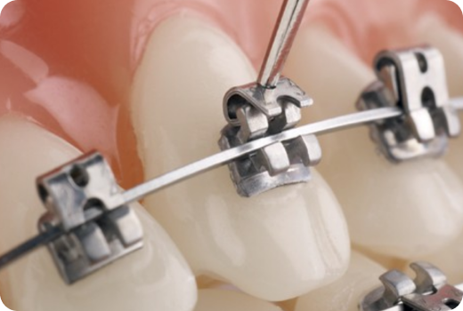 Why Self-ligating braces? Why Self-ligating braces?