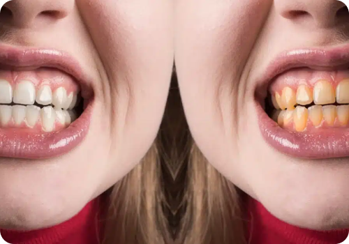Why Whitening?