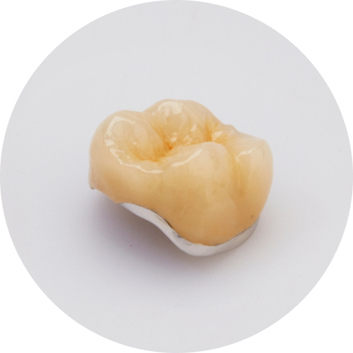 Porcelain Fused to Metal (PFM)