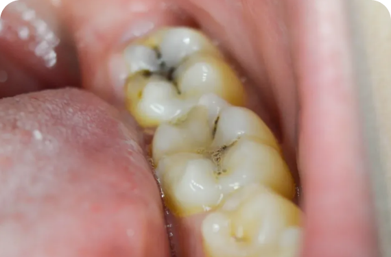 TOOTH DECAY