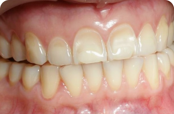 TOOTH EROSION