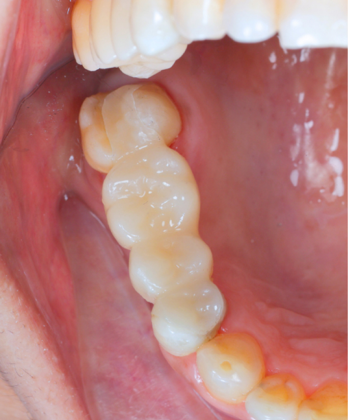 Tooth Restoration Tooth Restoration