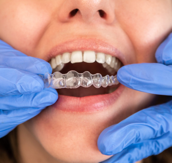 Why Choose Invisalign?