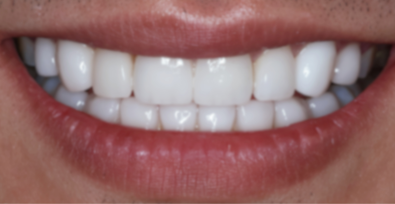 Mobile :: Subpage Masthead :: Porcelain Veneers