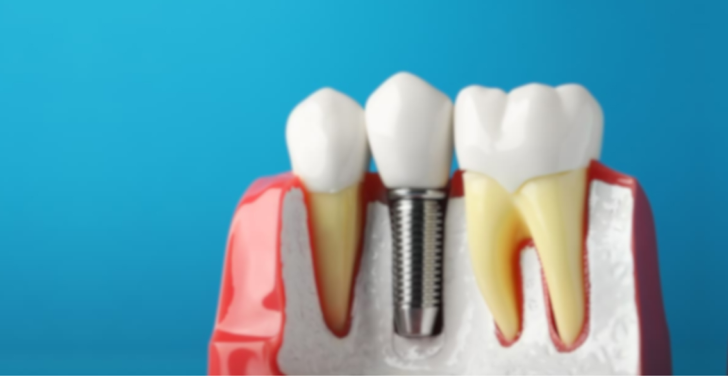 Mobile :: Subpage Masthead :: Implant