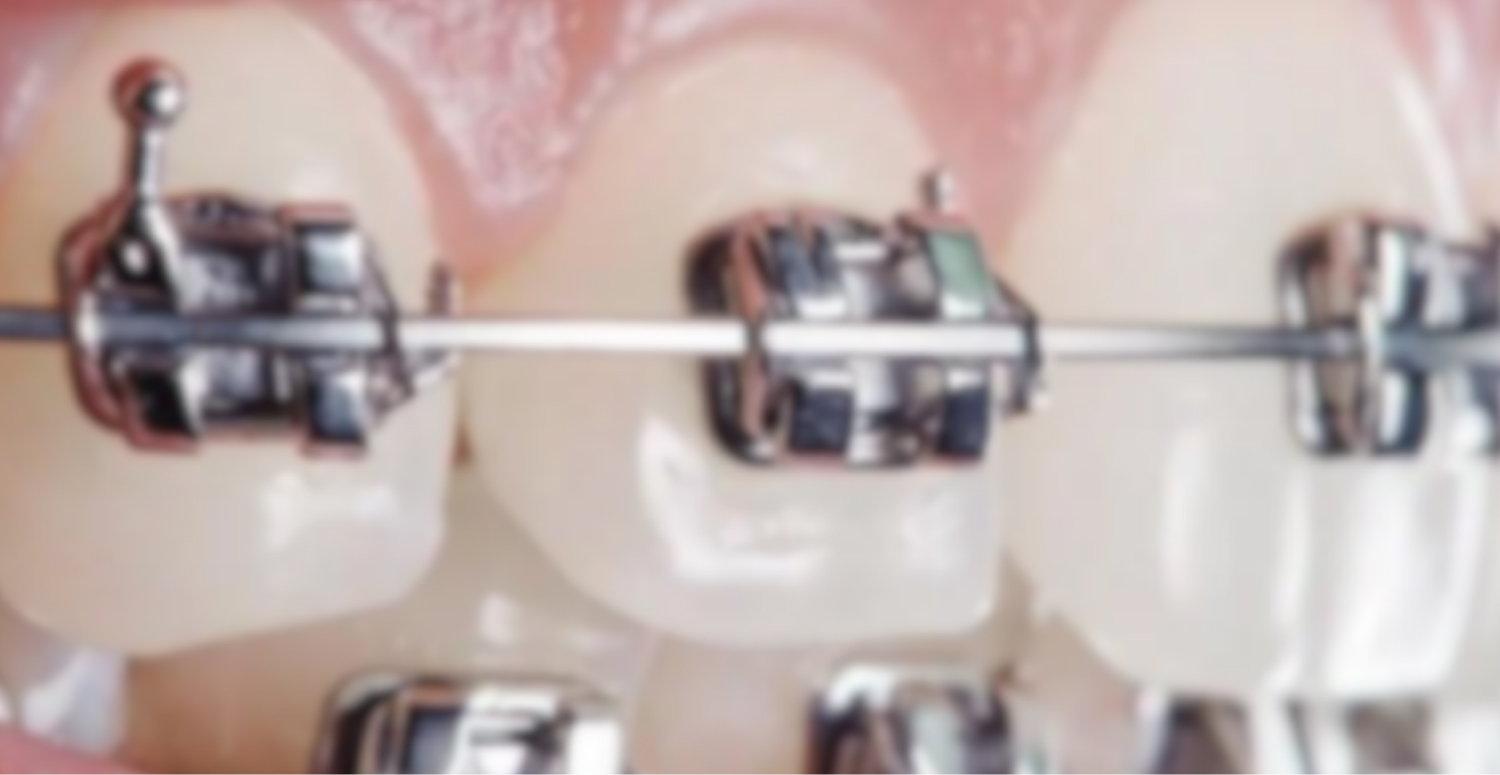 Mobile :: Subpage Masthead :: Self-Ligating Braces